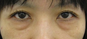目の下のたるみ、目のくまでお悩みの方、切らずに完璧に解決します。TCB-R法　手術直後　症例写真